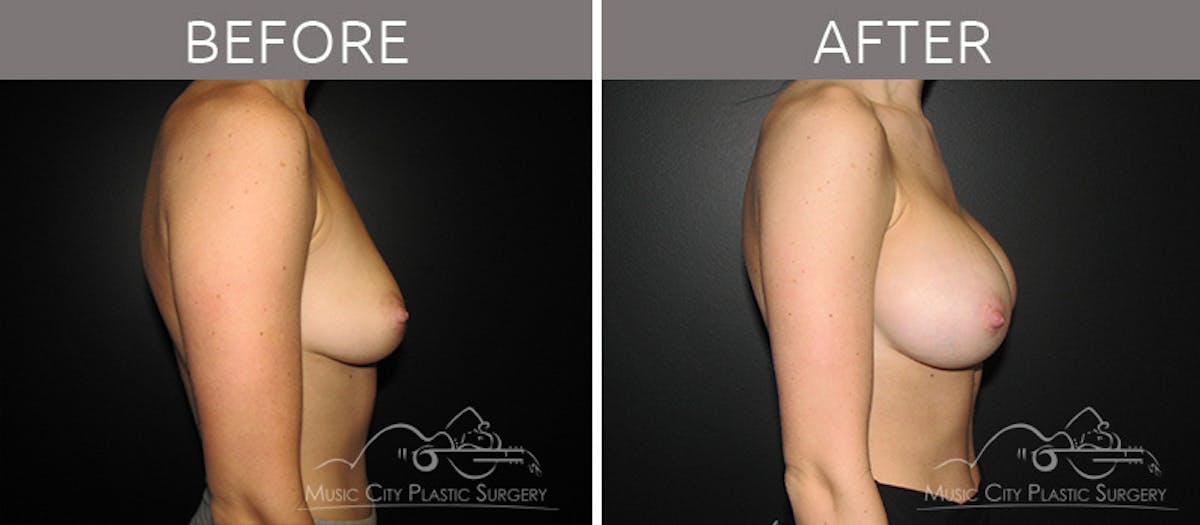 Breast Augmentation Before & After Gallery - Patient 90709190 - Image 3