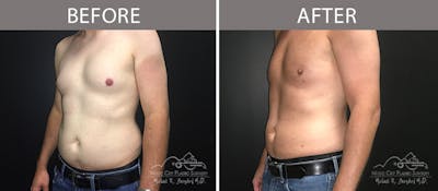 Male Liposuction Before & After Gallery - Patient 90709192 - Image 1