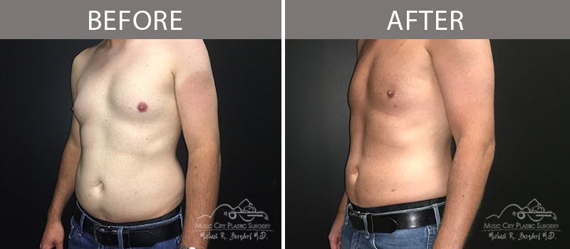 Liposuction Before & After Gallery - Patient 90709192 - Image 1