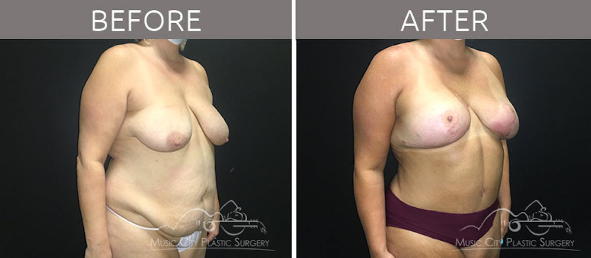 Breast Lift Before & After Gallery - Patient 90709191 - Image 4