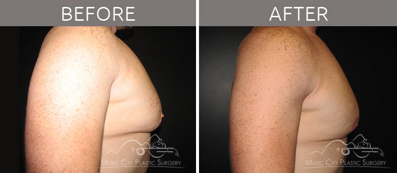 Gynecomastia Before & After Gallery - Patient 90709193 - Image 1