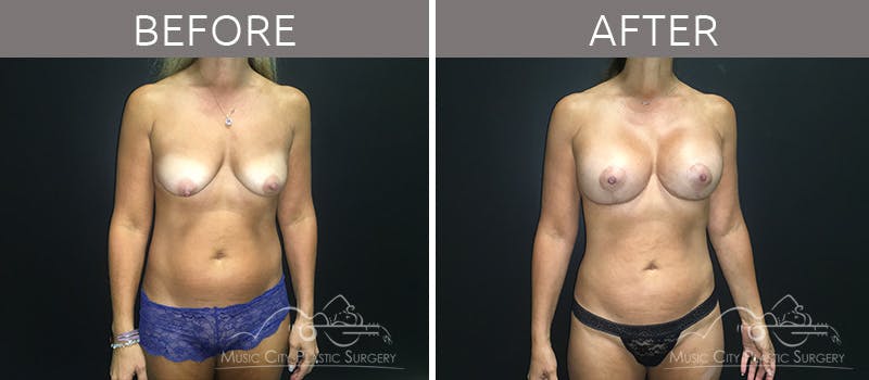 Mommy Makeover Before & After Gallery - Patient 90709199 - Image 1