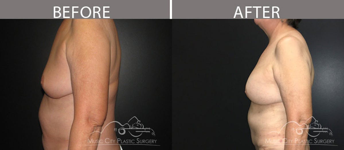 Abdominoplasty Before & After Gallery - Patient 90709189 - Image 3