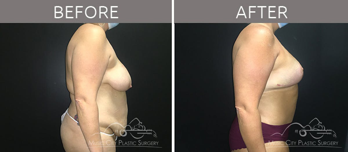 Breast Lift Before & After Gallery - Patient 90709191 - Image 5