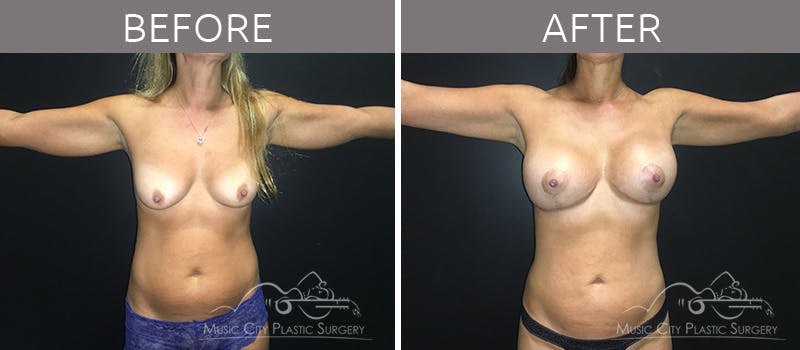 Mommy Makeover Before & After Gallery - Patient 90709199 - Image 4
