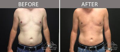 Male Liposuction Before & After Gallery - Patient 90709192 - Image 2