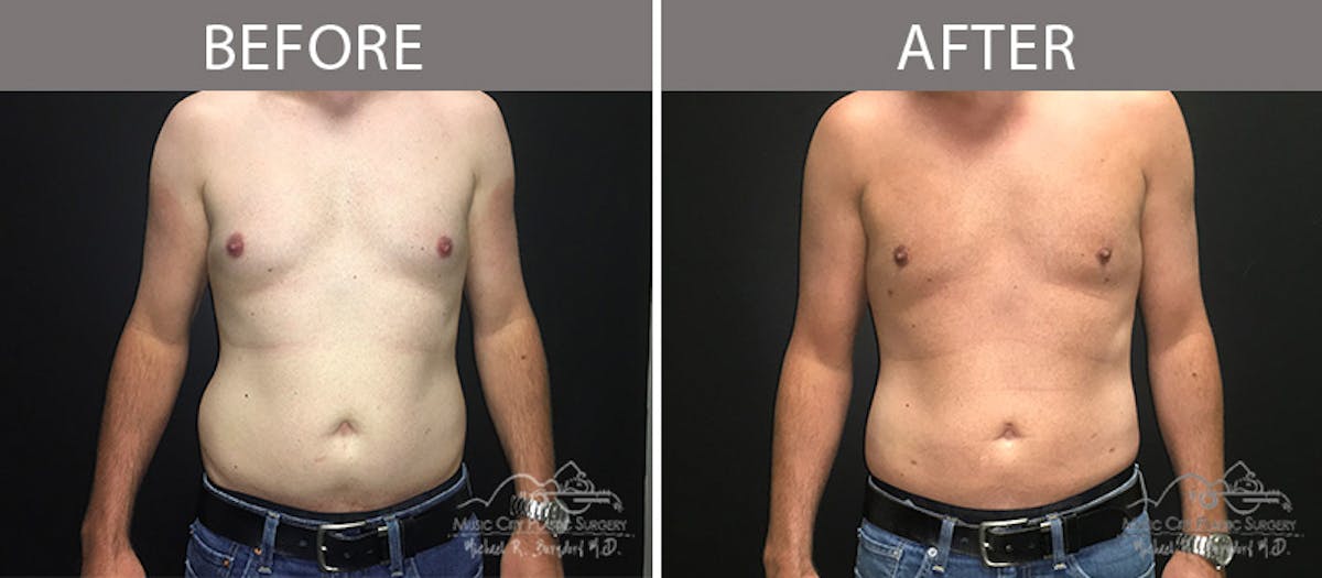 Liposuction Before & After Gallery - Patient 90709192 - Image 2