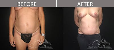 Abdominoplasty Before & After Gallery - Patient 90709195 - Image 1