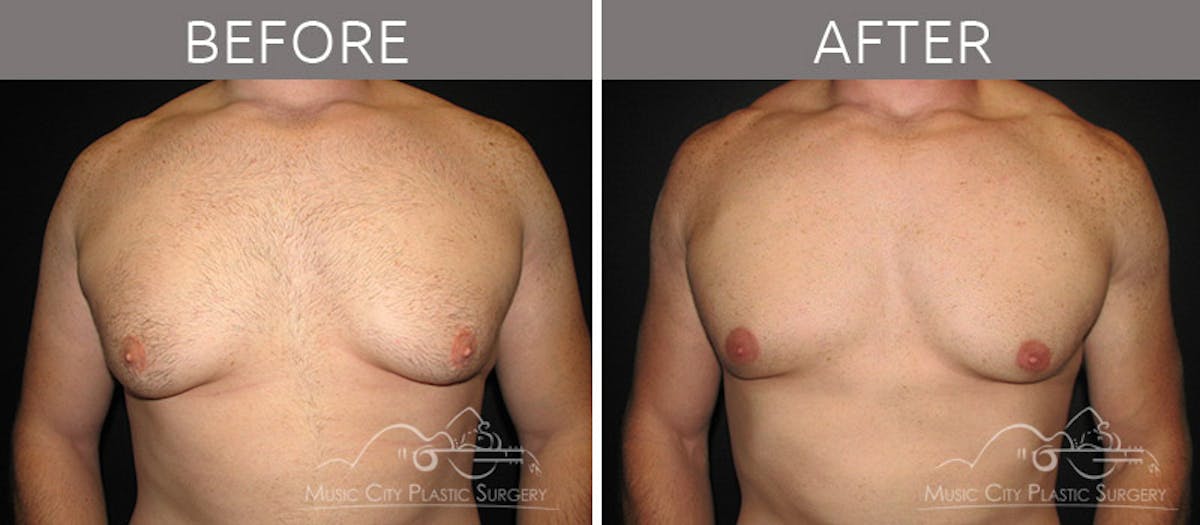 Gynecomastia Before & After Gallery - Patient 90709193 - Image 2