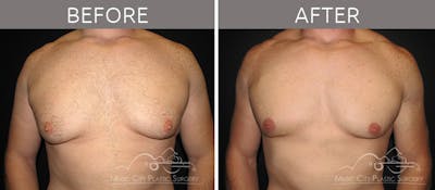 Gynecomastia Before & After Gallery - Patient 90709193 - Image 2