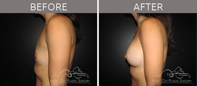 Breast Augmentation Before & After Gallery - Patient 90709196 - Image 3