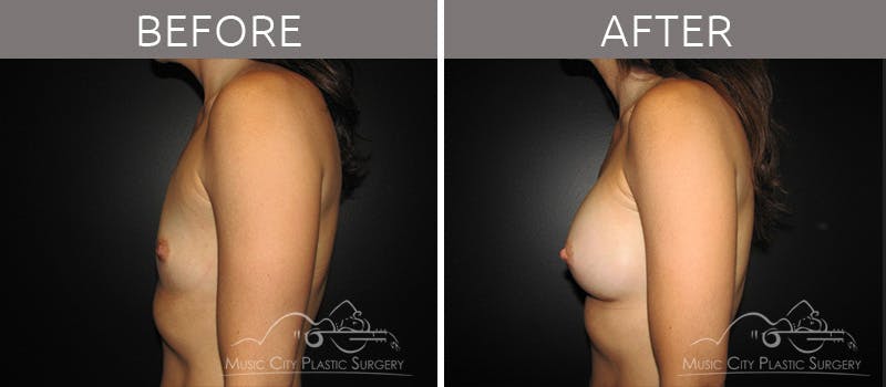 Breast Augmentation Before & After Gallery - Patient 90709196 - Image 3