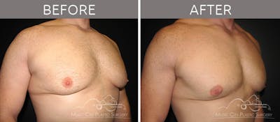 Gynecomastia Before & After Gallery - Patient 90709193 - Image 3
