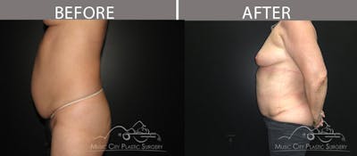 Abdominoplasty Before & After Gallery - Patient 90709195 - Image 2
