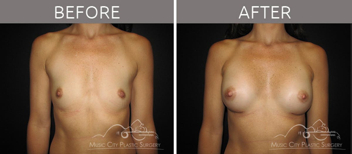 Breast Augmentation Before & After Gallery - Patient 90709196 - Image 1