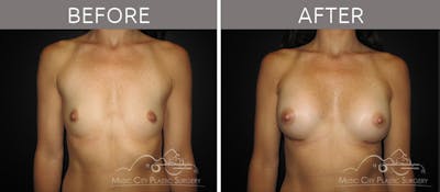 Breast Augmentation Before & After Gallery - Patient 90709196 - Image 1