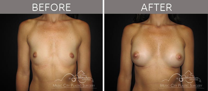 Breast Augmentation Before & After Gallery - Patient 90709196 - Image 2