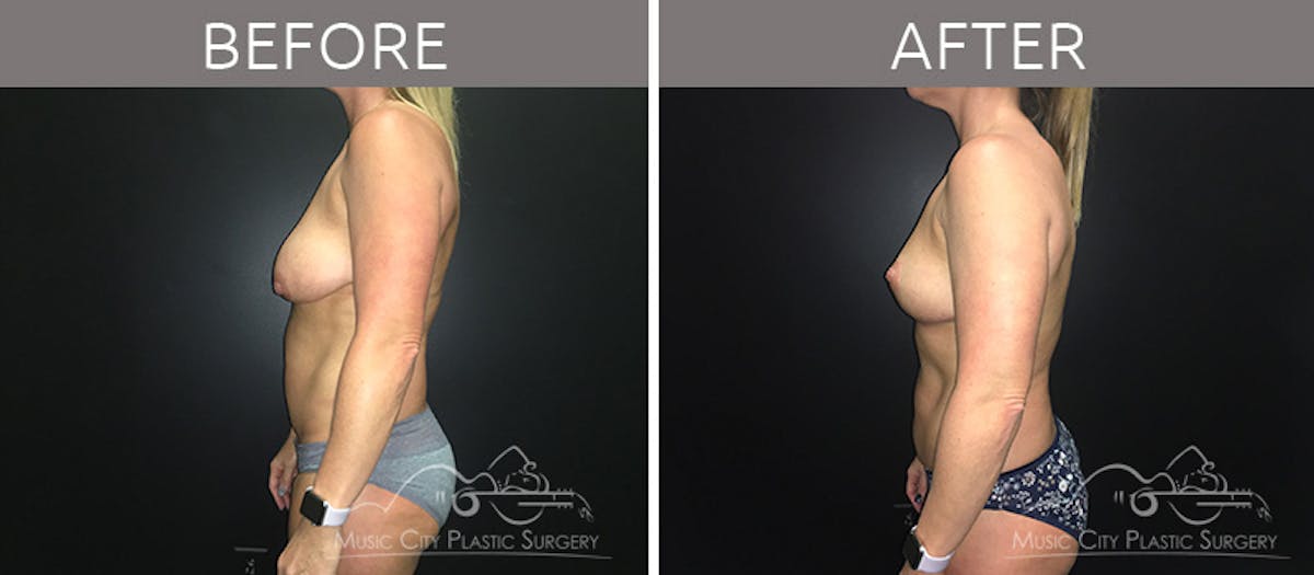 Breast Lift Before & After Gallery - Patient 90709197 - Image 3