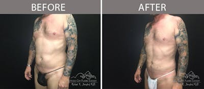 Male Liposuction Before & After Gallery - Patient 90709200 - Image 1