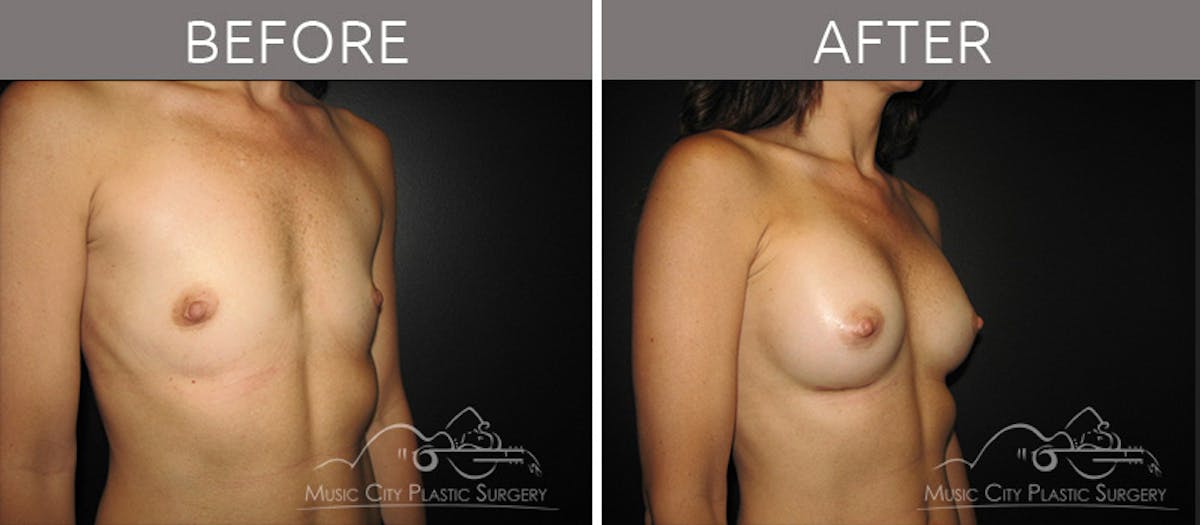 Breast Augmentation Before & After Gallery - Patient 90709196 - Image 2