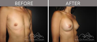 Breast Augmentation Before & After Gallery - Patient 90709196 - Image 2