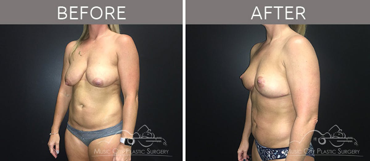 Breast Lift Before & After Gallery - Patient 90709197 - Image 2