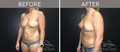 Breast Lift Before & After Gallery - Patient 90709197 - Image 2