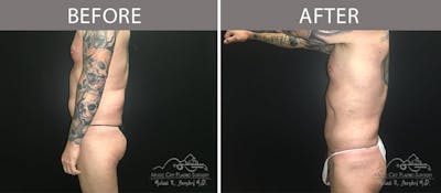 Male Liposuction Before & After Gallery - Patient 90709200 - Image 2