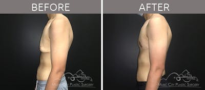 Gynecomastia Before & After Gallery - Patient 90709198 - Image 1