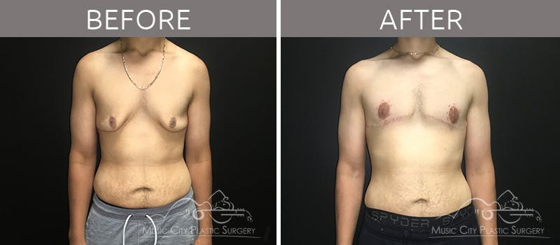 Gynecomastia Before & After Gallery - Patient 90709198 - Image 2