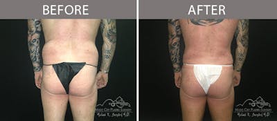 Male Liposuction Before & After Gallery - Patient 90709200 - Image 3