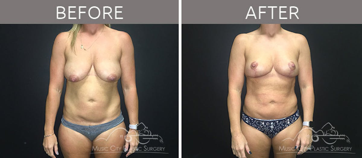 Breast Lift Before & After Gallery - Patient 90709197 - Image 1