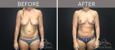 Breast Lift Before & After Gallery - Patient 90709197 - Image 1