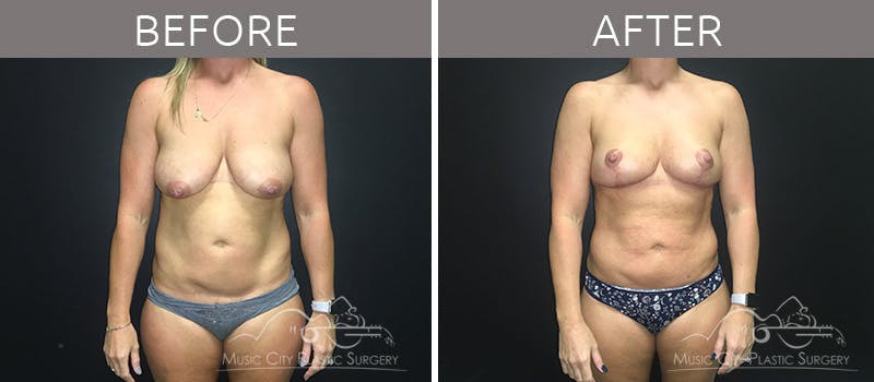 Breast Lift Before & After Gallery - Patient 90709197 - Image 3