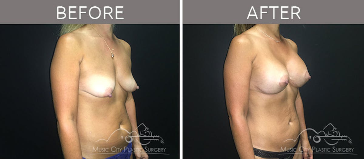 Mommy Makeover Before & After Gallery - Patient 90709199 - Image 7