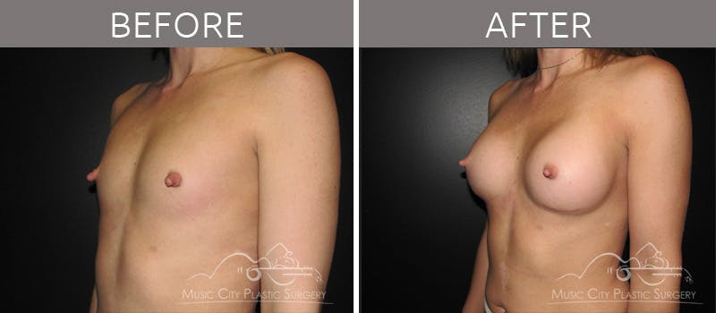 Breast Augmentation Before & After Gallery - Patient 90709201 - Image 1