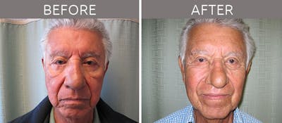 Blepharoplasty Before & After Gallery - Patient 90709203 - Image 1