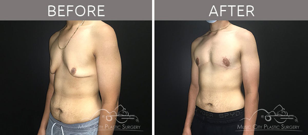Gynecomastia Before & After Gallery - Patient 90709198 - Image 3