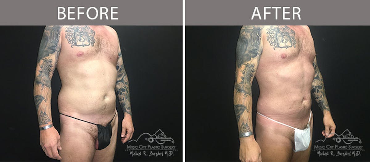 Male Liposuction Before & After Gallery - Patient 90709200 - Image 4