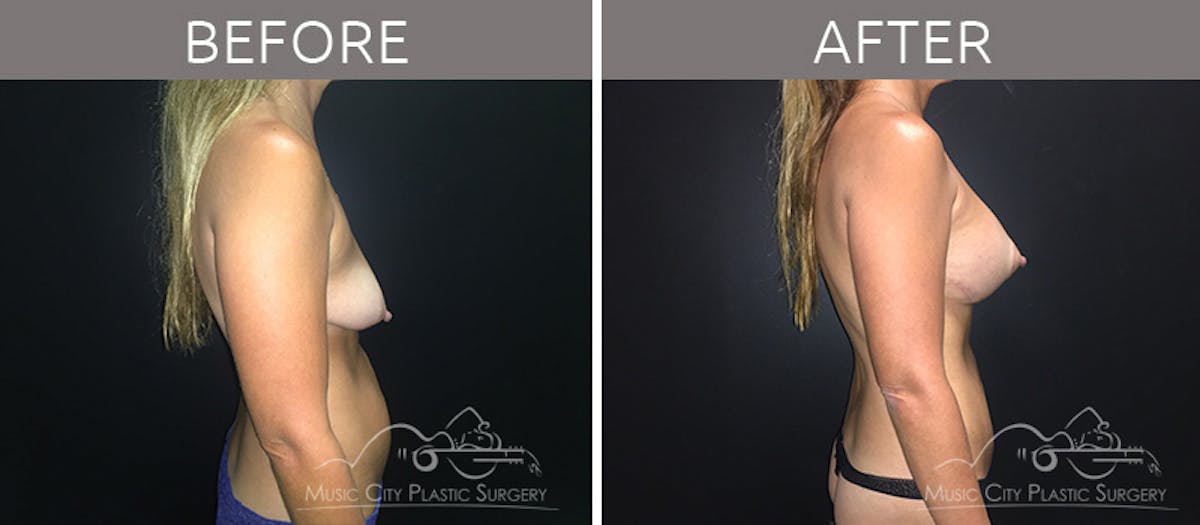 Mommy Makeover Before & After Gallery - Patient 90709199 - Image 8