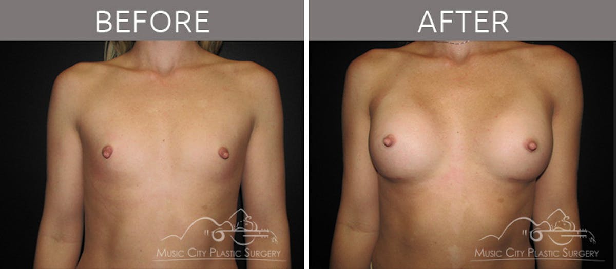 Breast Augmentation Before & After Gallery - Patient 90709201 - Image 1