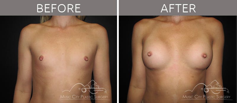 Breast Augmentation Before & After Gallery - Patient 90709201 - Image 1