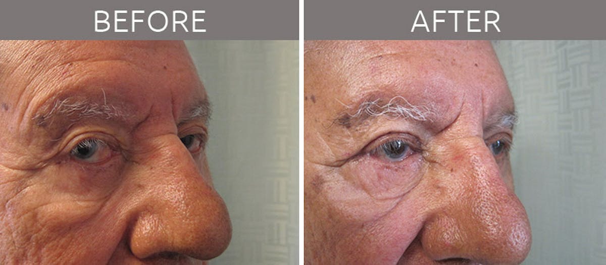 Blepharoplasty Before & After Gallery - Patient 90709203 - Image 2