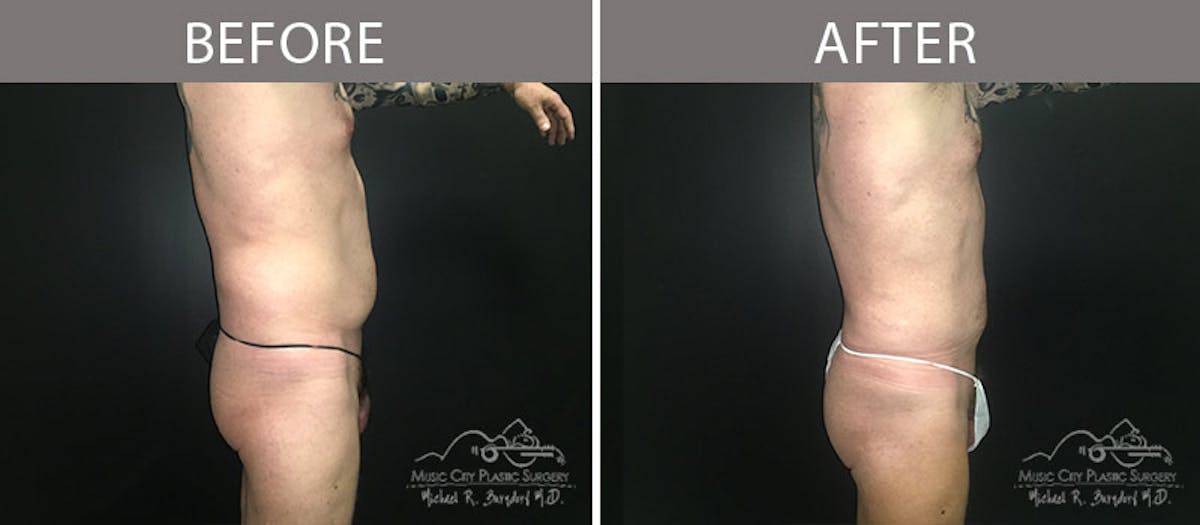 Male Liposuction Before & After Gallery - Patient 90709200 - Image 5