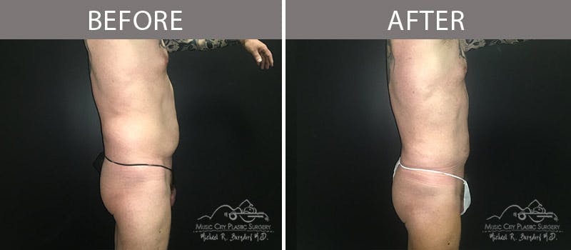 Liposuction Before & After Gallery - Patient 90709200 - Image 5