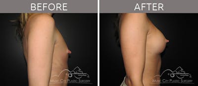 Breast Augmentation Before & After Gallery - Patient 90709201 - Image 3
