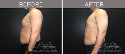 Gynecomastia Before & After Gallery - Patient 90709204 - Image 1