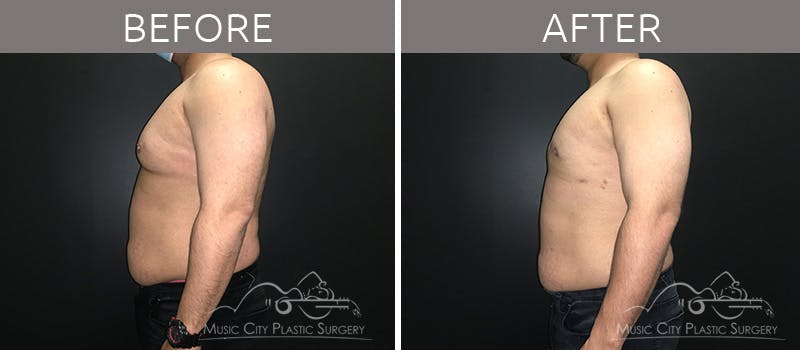 Gynecomastia Before & After Gallery - Patient 90709204 - Image 1