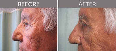 Blepharoplasty Before & After Gallery - Patient 90709203 - Image 3