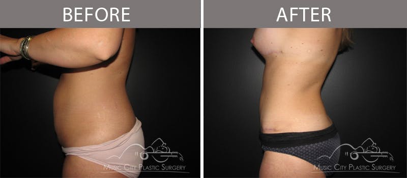 Mommy Makeover Before & After Gallery - Patient 90709210 - Image 2